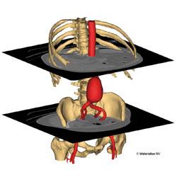 Aortic aneurysm (by Materialise NV)